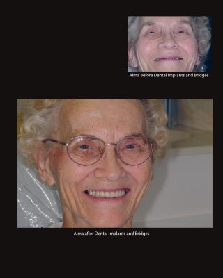 Before and after dental implants and bridges