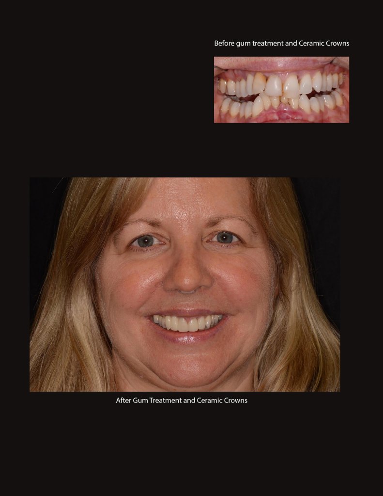 Before and after gum treatment and ceramic crowns