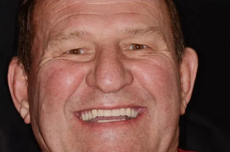 Patient after dental implants and implant-supported teeth