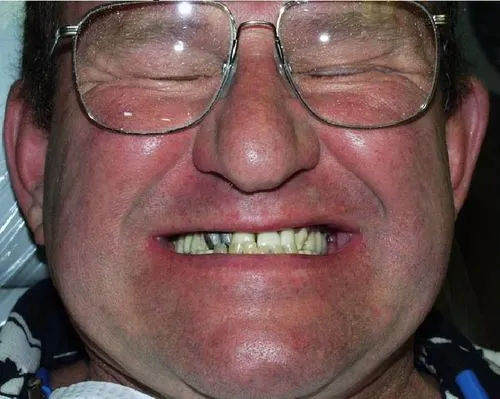 Patient before dental implants and implant-supported teeth