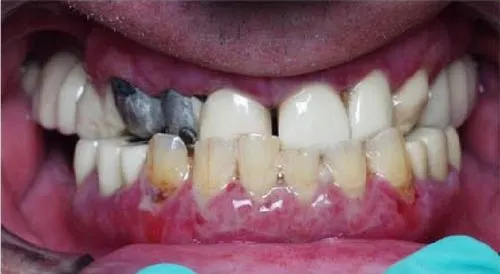 Patient's mouth before dental implants and implant-supported teeth