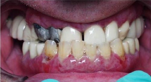 Patient's mouth before dental implants and implant-supported teeth