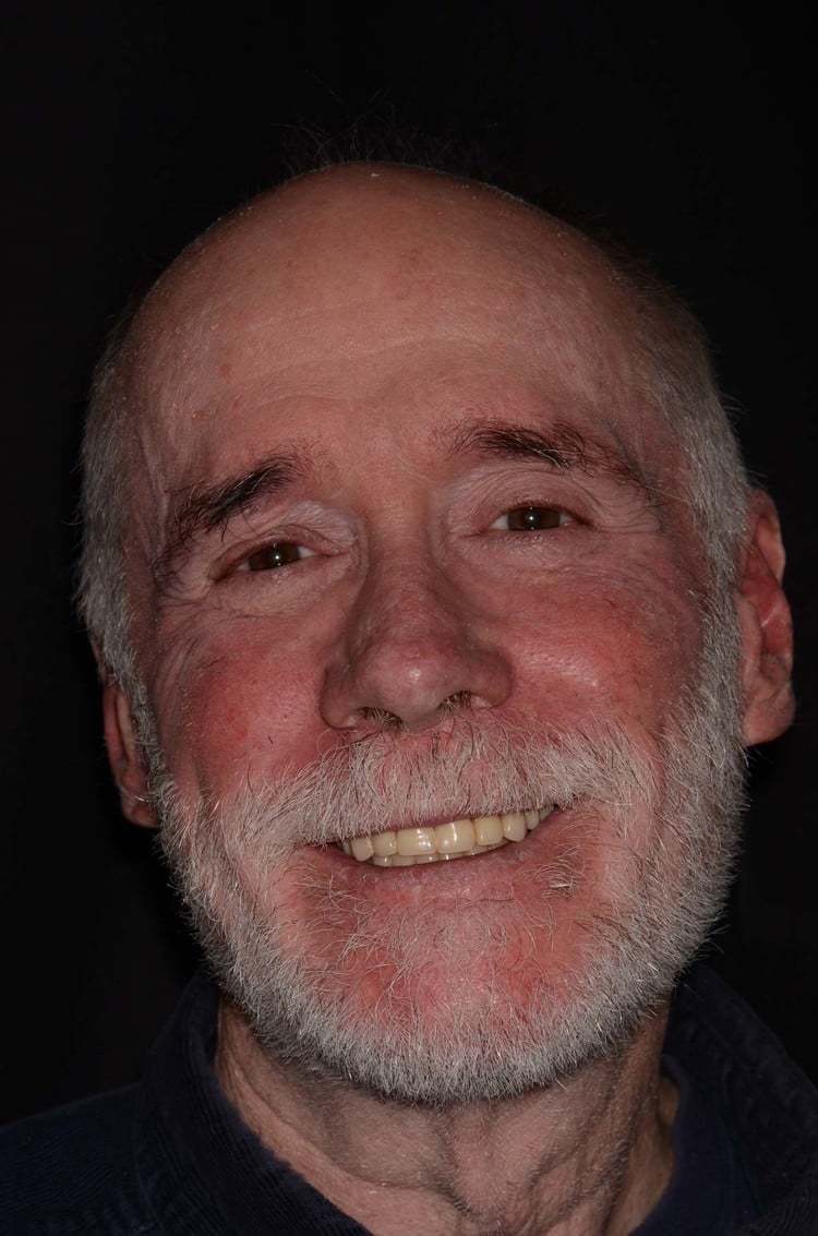Patient after dental implants and implant-supported overdentures