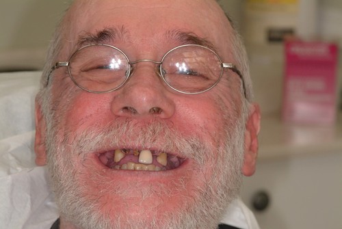 Patient before dental implants and implant-supported overdentures