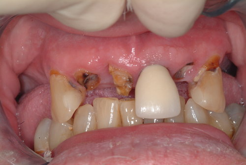 Patient mouth before dental implants and implant-supported overdentures