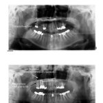 Before and after x-ray of a sinus lift