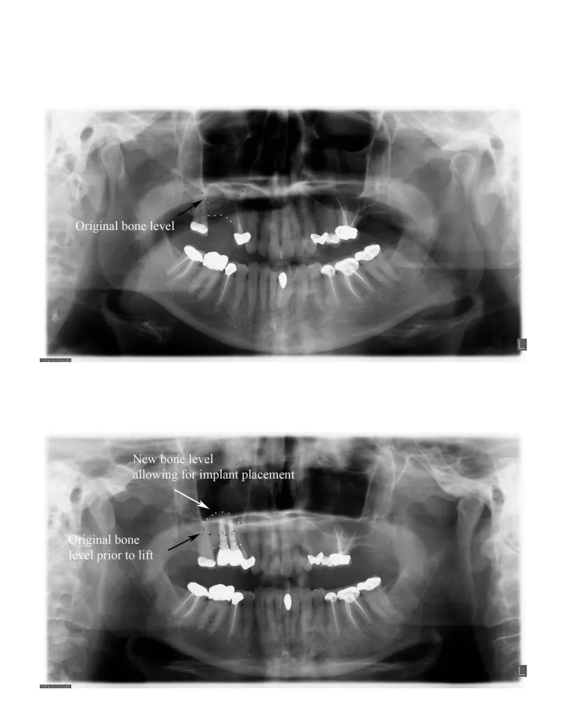 Before and after x-ray of a sinus lift
