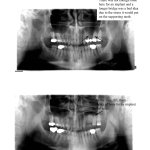 Before and after x-ray of a sinus lift