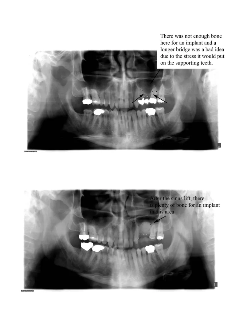 Before and after x-ray of a sinus lift