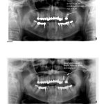 Before and after x-ray of a sinus lift