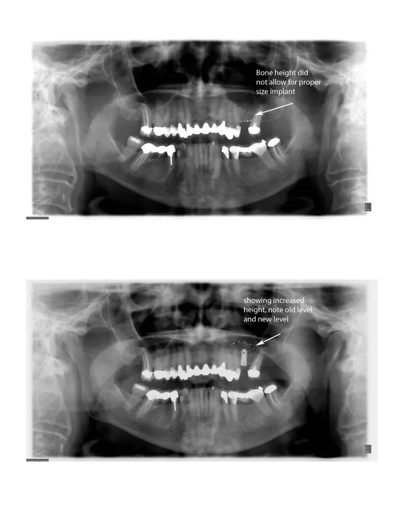 Before and after x-ray of a sinus lift