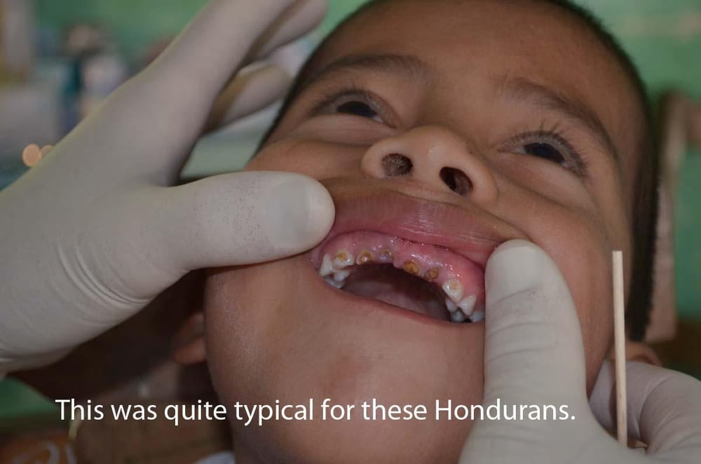 A patient with rotted front teeth
