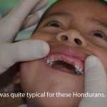 A patient with rotted front teeth